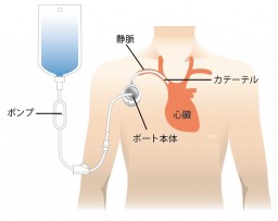 皮下埋め込み型中心静脈ポートイメージ図