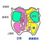 副鼻腔・炎